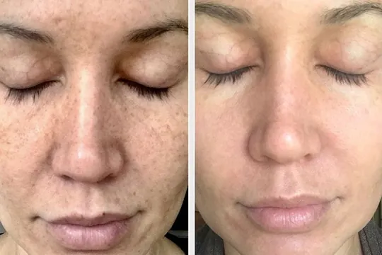 Tratamiento BB Glow, antes y después
